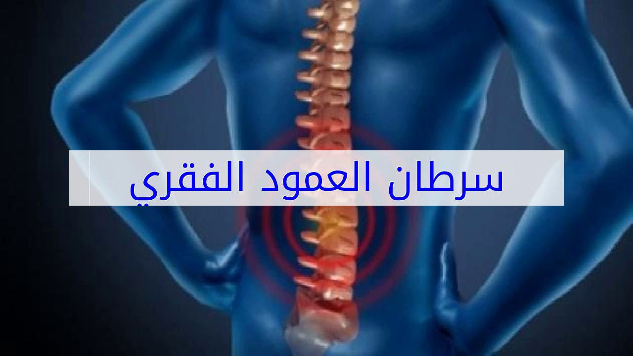 اعراض سرطان العمود الفقري , اعراض و اسباب الورم الفقري