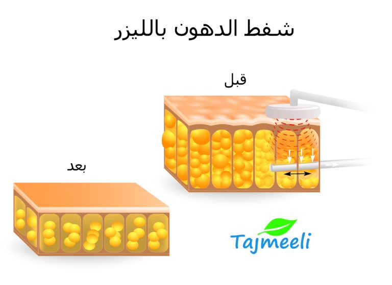 تفتيت الدهون بالليزر , معلومة عن شفط الدهون بالليزر