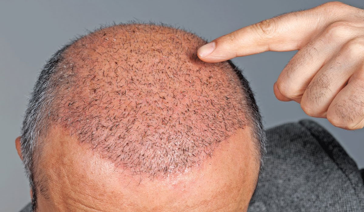 ما بعد عملية زراعة الشعر - نصائح يجب اتباعها بعد زرع الشعر 4422 2