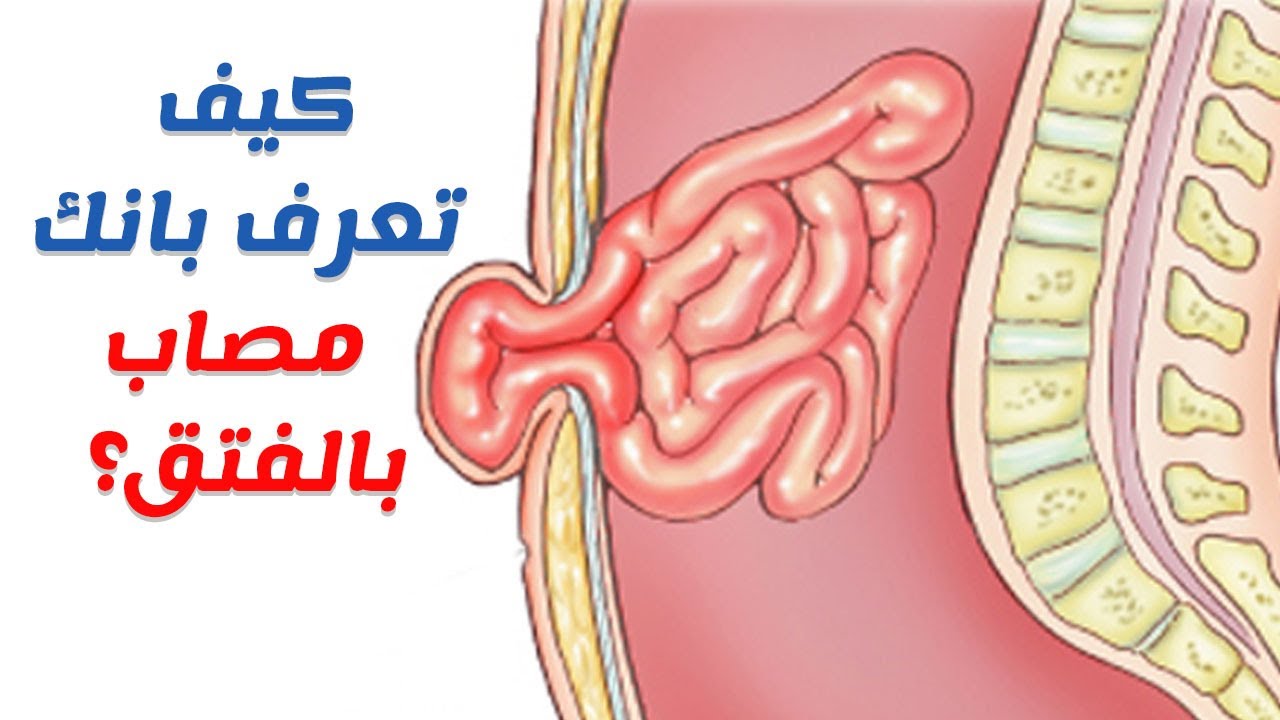 ما هو الفتاق - ما هى اسباب وعلاج الفتاق 6109 1