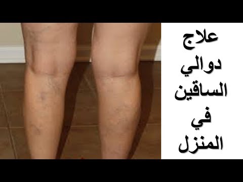 علاج الدوالي بالاعشاب , وصفات طبيعيه لعلاج دوالي الساقين