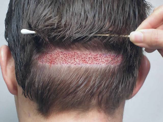 زراعة الشعر بتركيا - يهم بعض من الشباب 4979