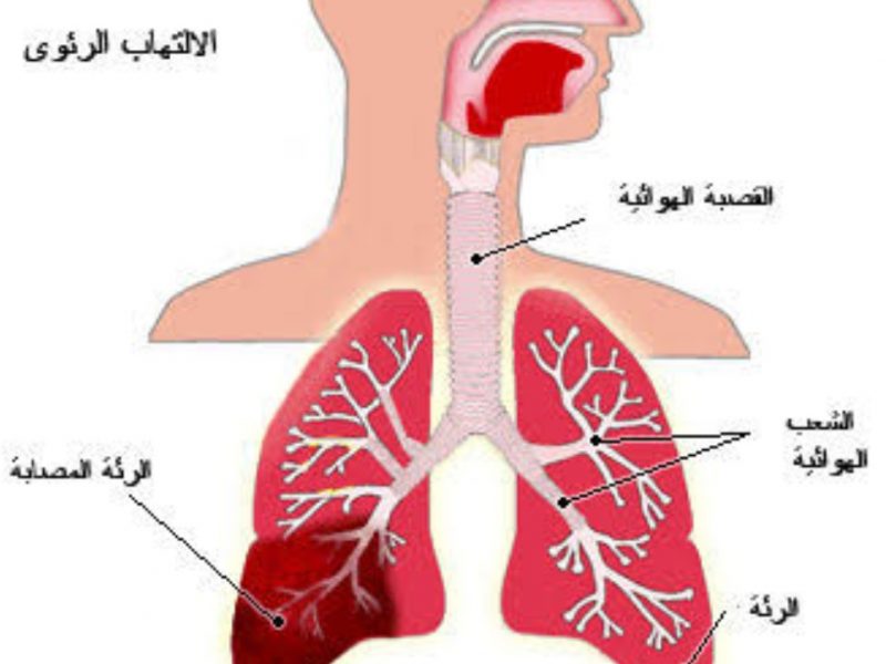 علاج الحساسية الصدرية بالقرنفل - من ابشع الامراض 5061 1