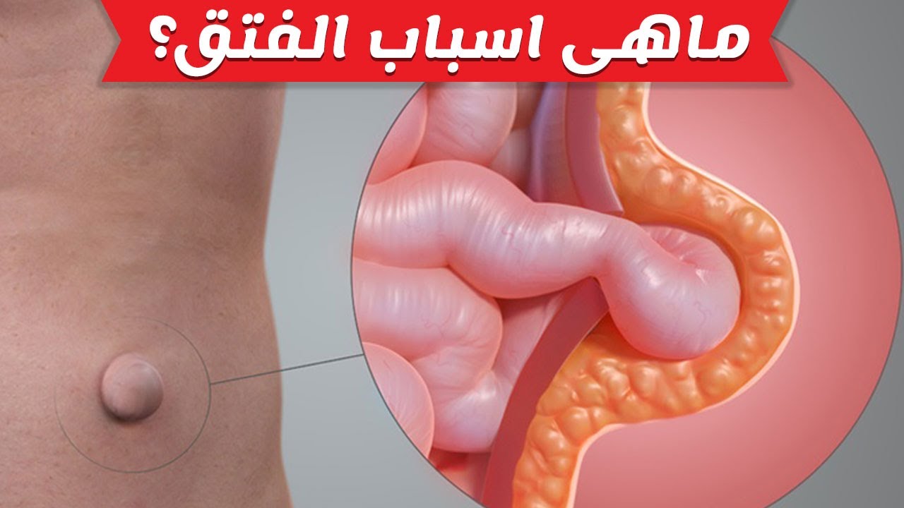 ما هو الفتاق - ما هى اسباب وعلاج الفتاق 6109