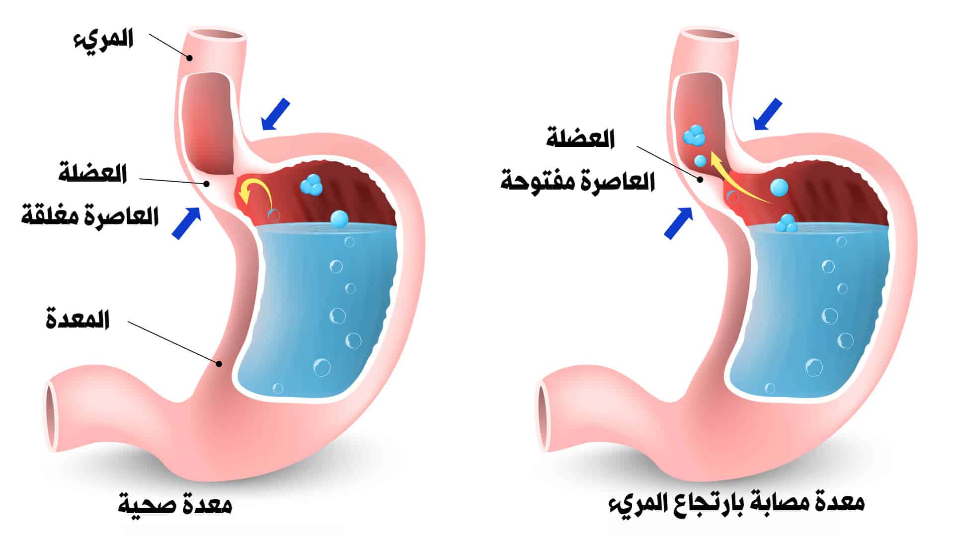 اعراض قرحة المريء , اسباب ومضاعفات الاصابه بالتهاب المرئ