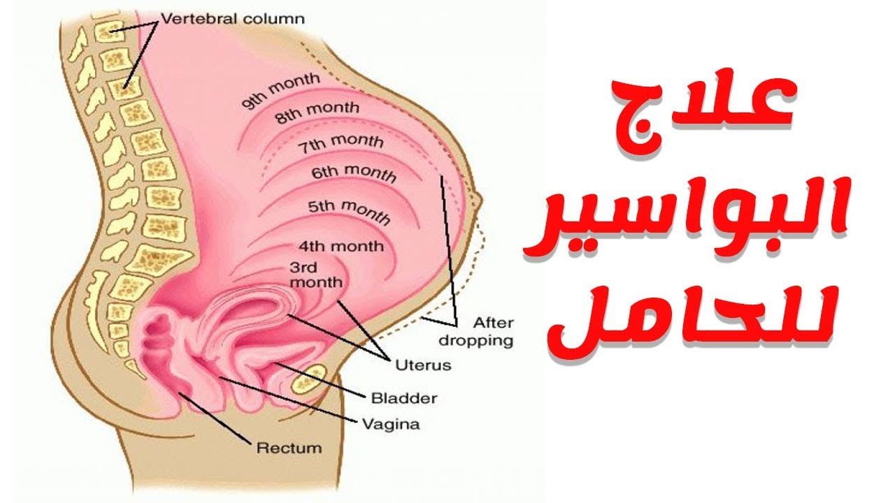 علاج البواسير عند الحامل - التخلص من البواسير عند الحامل 5635 3