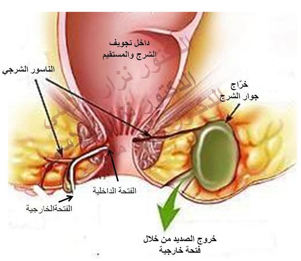 كم تكلفة عملية الناسور - كيفيه علاج الناسور بالليزر 2801 2