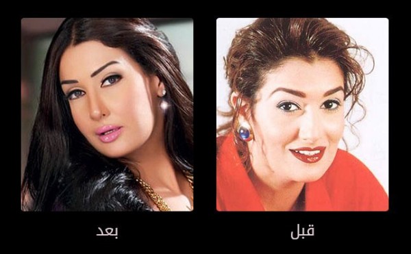 الصور الفنانات قبل وبعد عمليات التجميل , تشوه الفنانات بسبب عمليات التجميل