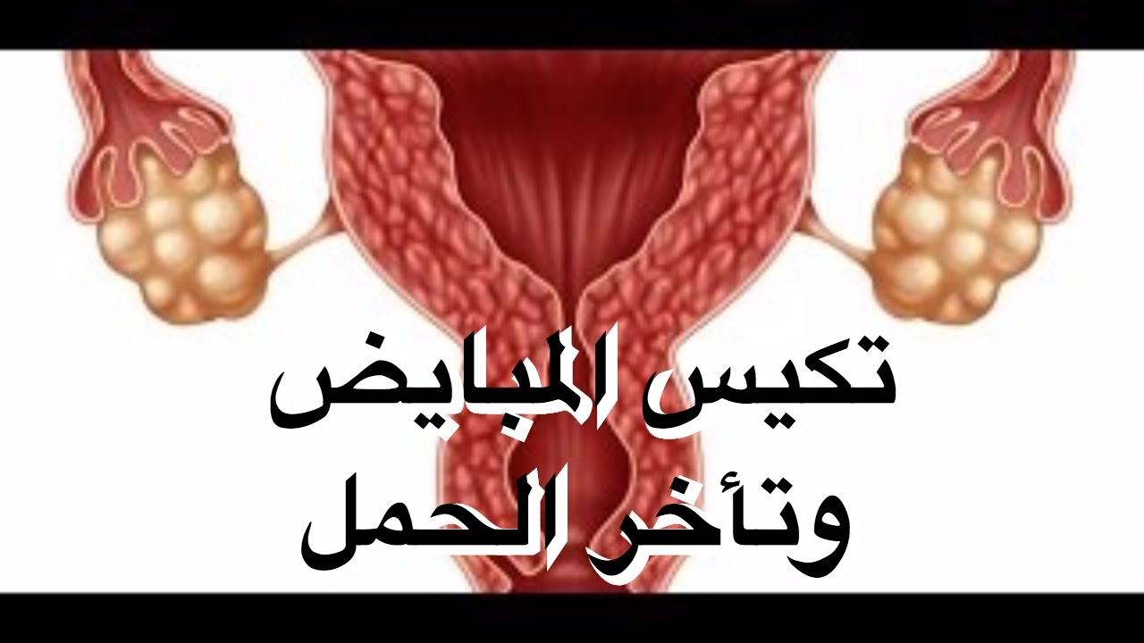 هل تكيس المبايض يسبب العقم - يهم كل السيدات جدا 4932