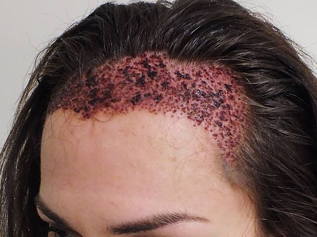 زراعة الشعر بتركيا - يهم بعض من الشباب 4979 1