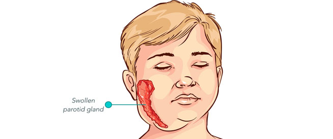 اعراض الغده النكافيه - مضاعفات الغده النكافيه 3753 1