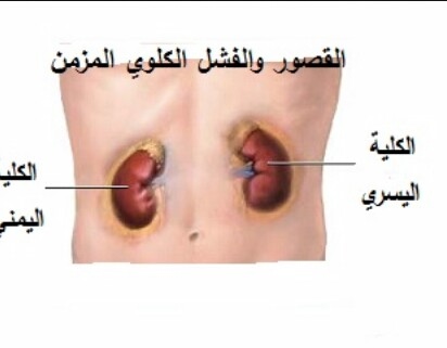 اعراض الفشل الكلوي المبكر - اغراض قصور الكلي 3098 1