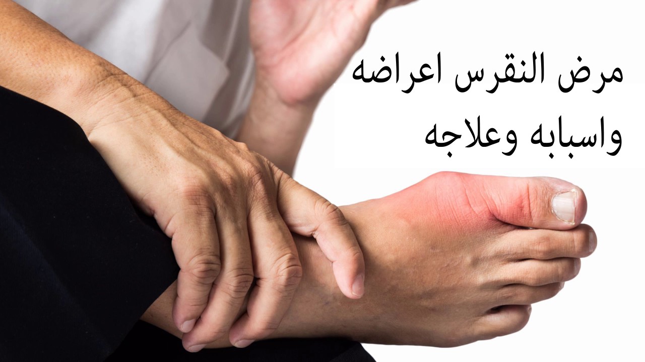 مرض النقرس واعراضه , يعاني منه البعض