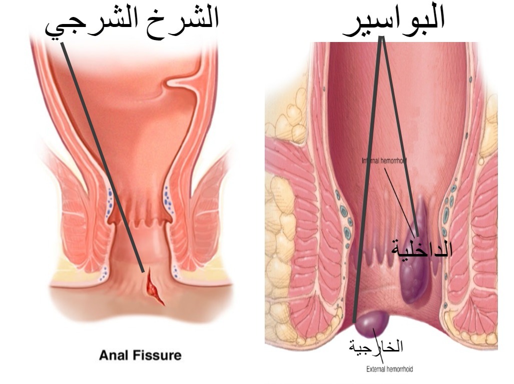 علاج الباسور الخارجي - طرق مختلفة لعلاج البواسير بالمنزل 2146 1