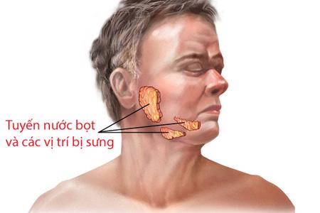 اعراض الغده النكافيه , مضاعفات الغده النكافيه