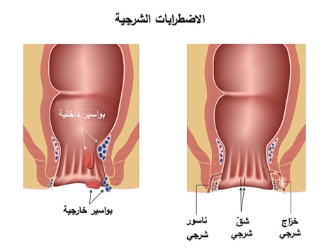 كم تكلفة عملية الناسور - كيفيه علاج الناسور بالليزر 2801 1