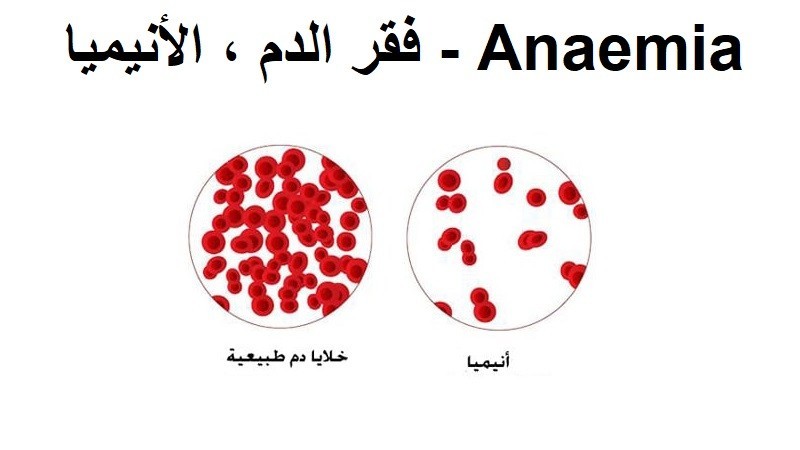 اعراض مرض الانيميا - علامات تدل علي انك تعاني من الانيميا 1128 1