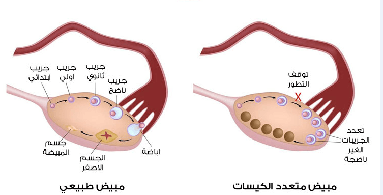 علاج التكيسات على المبايض،اعراض تكيسات المبايض و طرق علاجها 3488