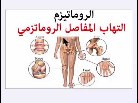 هل روماتيزم الدم خطير - العوامل التى تجعل هذا المرض خطير جدا 2613 3