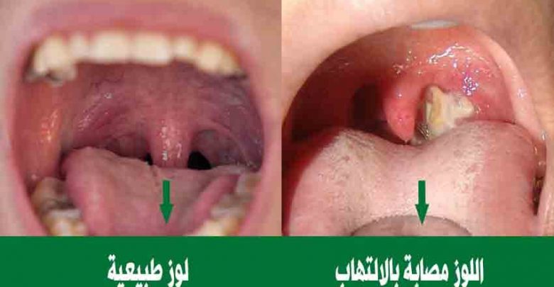 علاج احتقان اللوز - ادويه لعلاج التهاب اللوز 2923