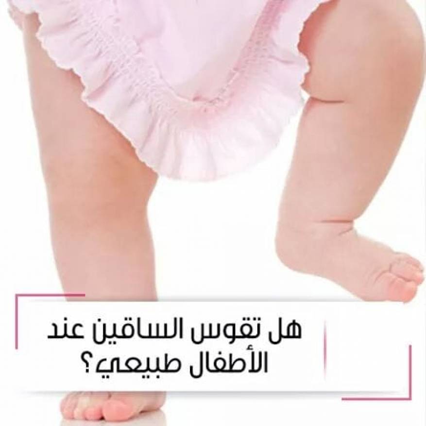 تقوس الساقين عند الاطفال بالصور , من اكثر الظواهر شيوعا في الاطفال