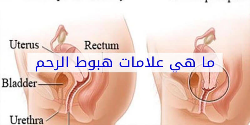 اعراض نزول الرحم،اسباب نزول الرحم و مدي خطوره ذلك 3258