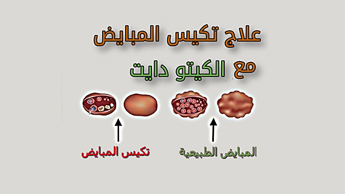 علاج التكيسات على المبايض،اعراض تكيسات المبايض و طرق علاجها 3488