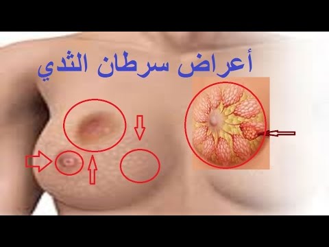 اعراض سرطان الثدي - علامات الاصابه بسرطان الثدي 3802