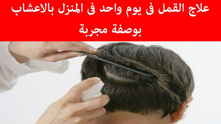 طرق التخلص من القمل - يوجد في كثير من الاطفال 5087 1