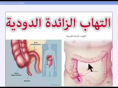 عمليه الزائده الدوديه - معلومات عن الزائدة الدودية 4906 1