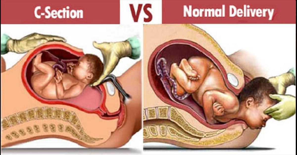 اضرار الولادة القيصرية - ايهما افضل الولادة القيصرية ام الولادة الطبيعية - 2248 3