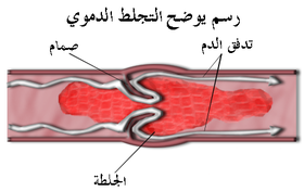 ما هو تخثر الدم - جلطات الدم اسبابها وعلاجها- 2488