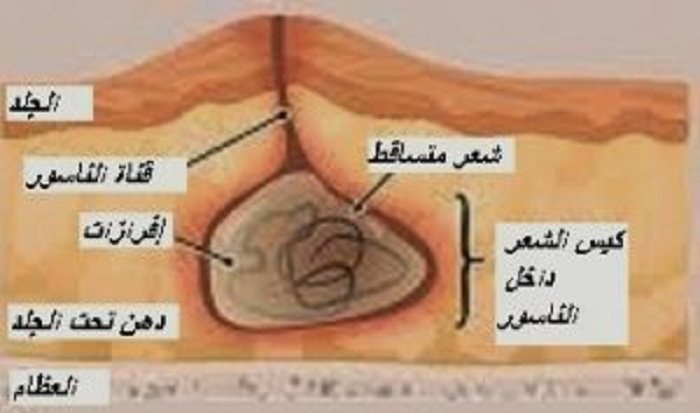 علاج كيس الشعر - يحدث لدي الكثير وخاصة الرجال 5121 1