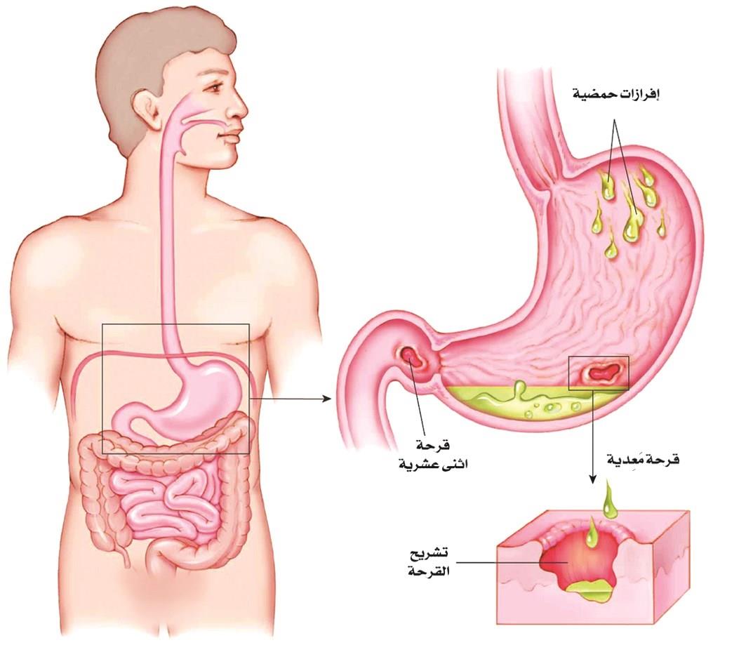 اعراض قرحة الاثنى عشر - هيا من ابشع الامراض 5646 1