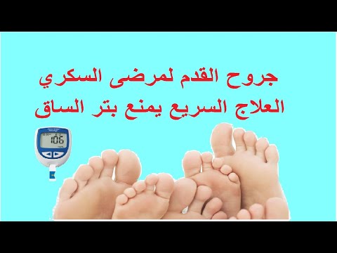 علاج جروح القدم لمرضى السكري بالاعشاب - وصفات طبيعيه لعلاج جروح القدم السكري 3859