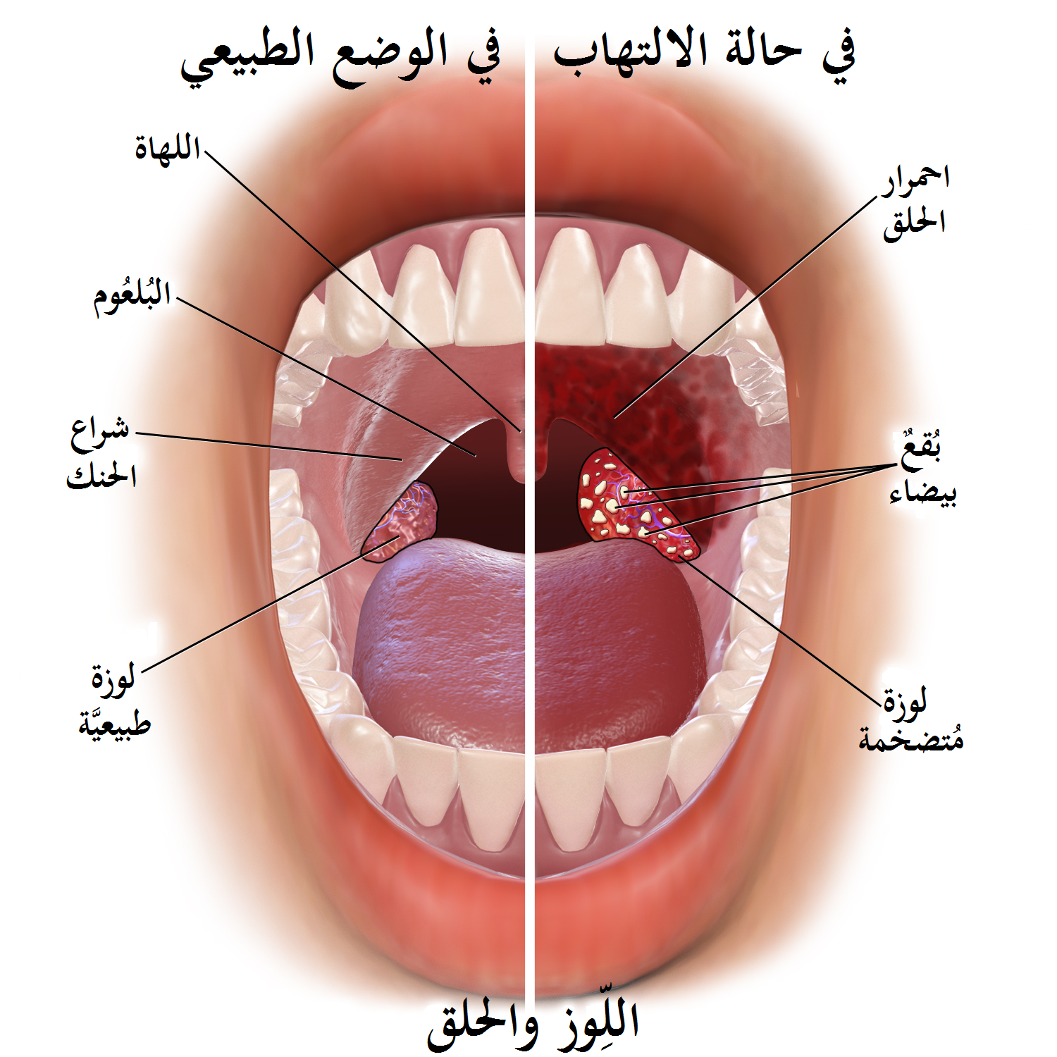 علاج احتقان اللوز - ادويه لعلاج التهاب اللوز 2923