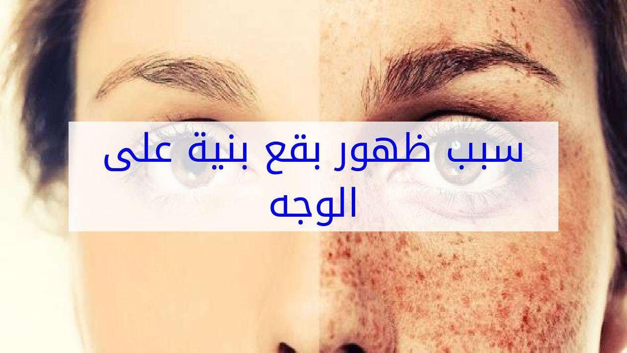 بقع بنية على الوجه - اسباب وعلاج البقع البنيه فى الوجه 5884 3