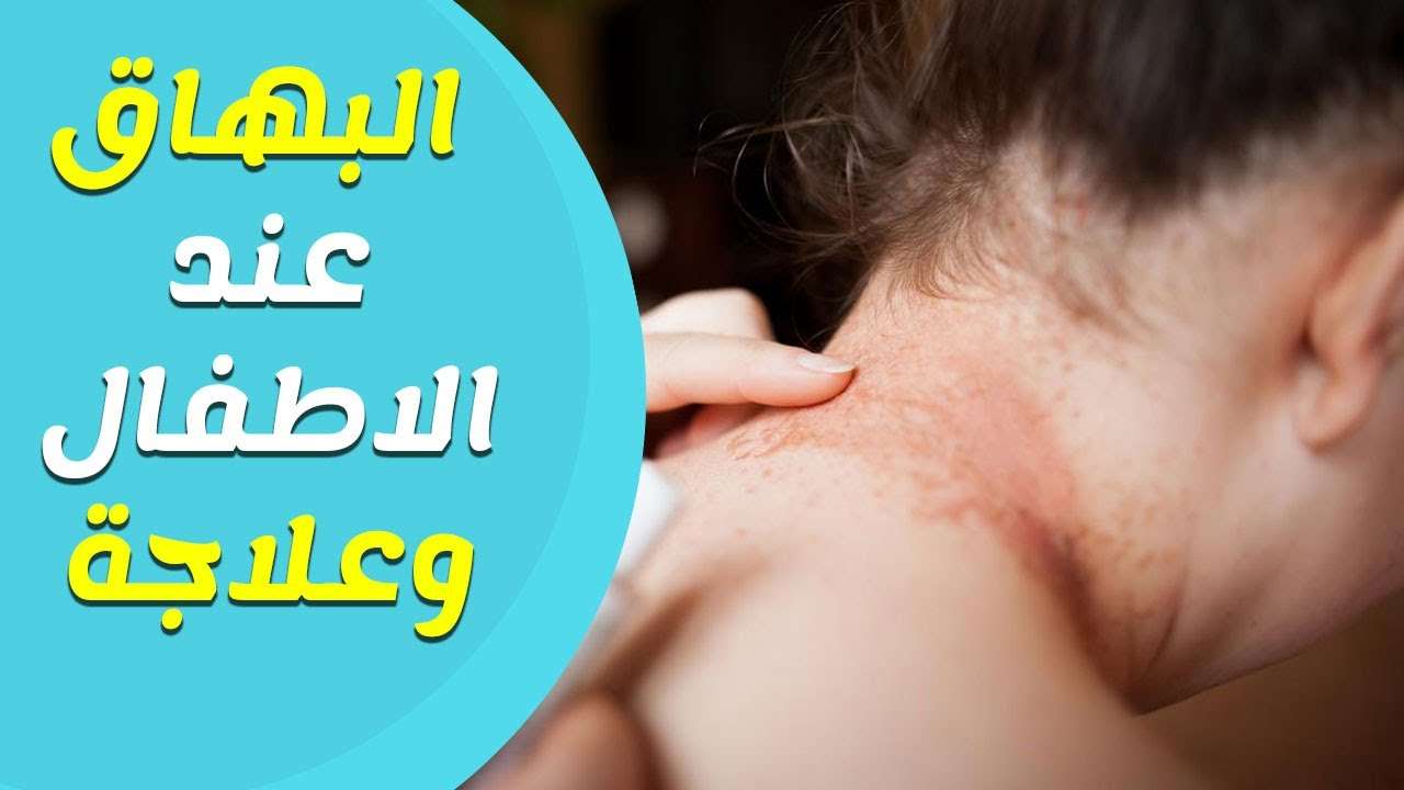 ماهو علاج البهاق - احدث طرق لعلاج البهاق 4339 2