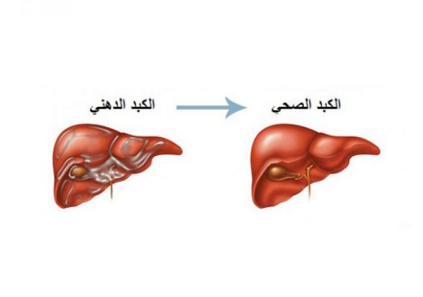 علاج دهون الكبد جابر القحطاني - من اكثر الاوجاع 4849 1