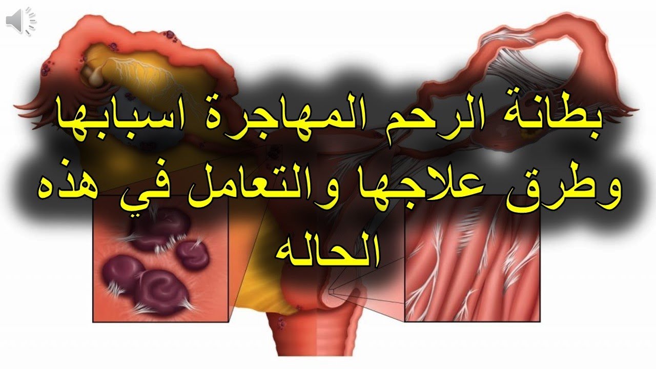 اعراض بطانة الرحم - ما هي بطانه الرحم المهاجره واعراضها 4248 2