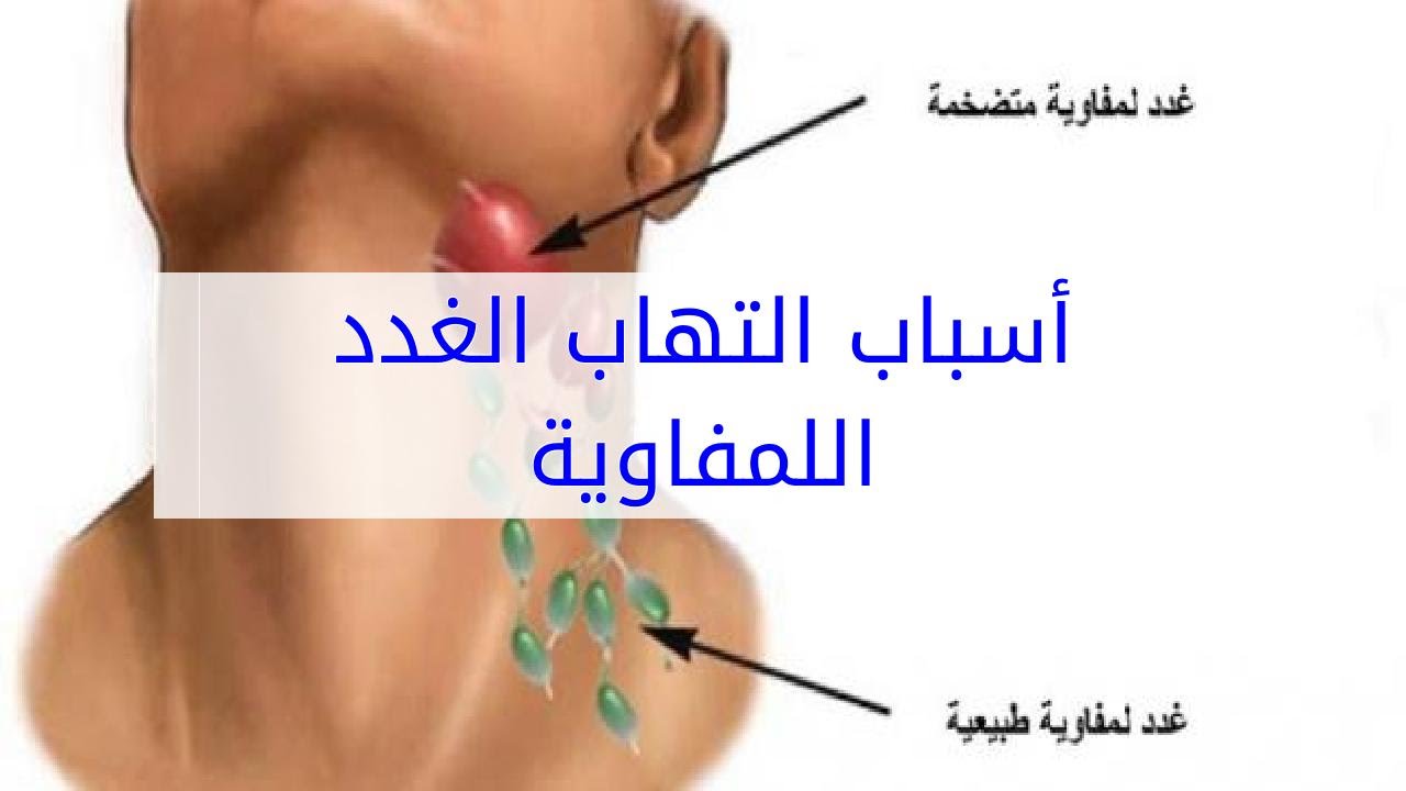 الغدد اللمفاوية في الرقبة بالصور - التهابات الغدد اللمفاويه 4274