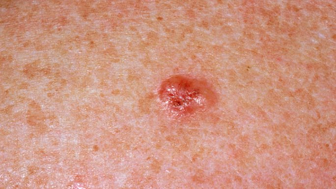 هل سرطان الجلد قاتل