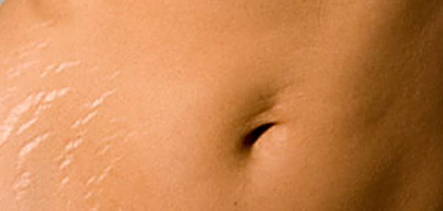 علاج تمدد الجلد , التخلص من الخطوط البيضاء بوسائل طبيعية شوق وغزل