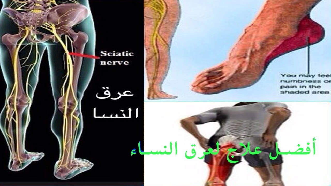 العلاج الفعال لعرق النسا , خطوات سريعة لعلاج عرق النسا