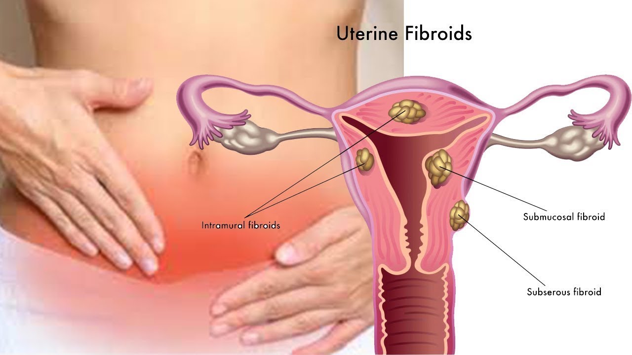 4832 علاج الفيبروم في الرحم بالاعشاب - اصبح منتشر جدا ميادة مرعي