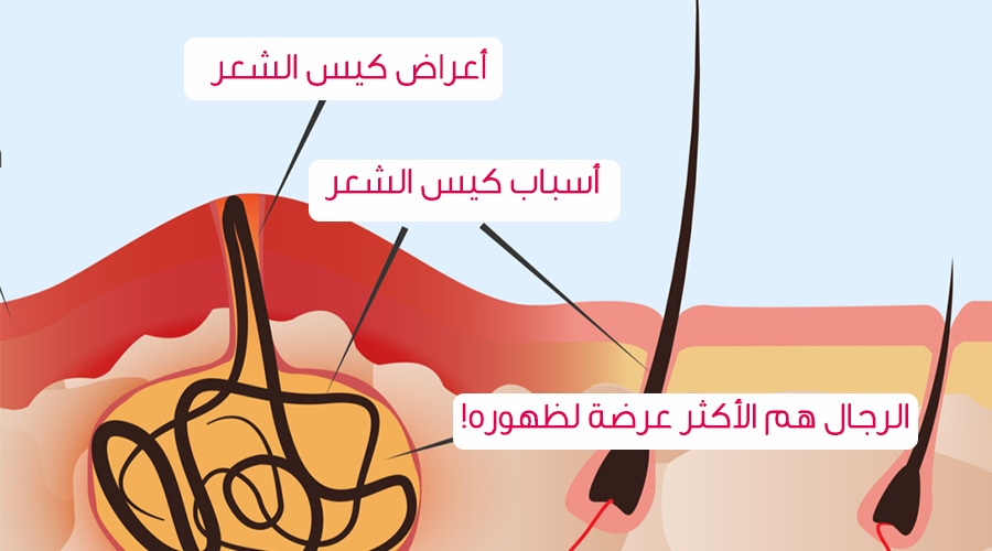 علاج كيس الشعر , يحدث لدي الكثير وخاصة الرجال