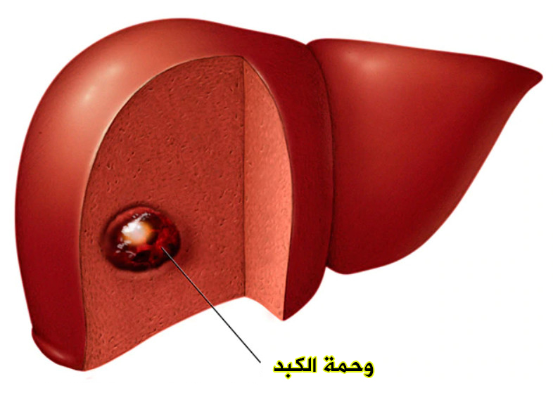 علاج وحمة الكبد بالاعشاب , ماهي وحمة الكبد